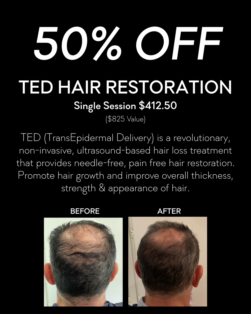 50% Off TED Hair Restoration