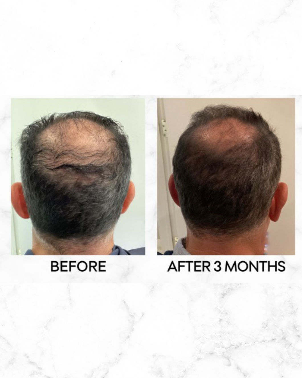 TED Hair Restoration